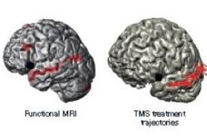 Robô para Neuronavegação Robô para Neuronavegação